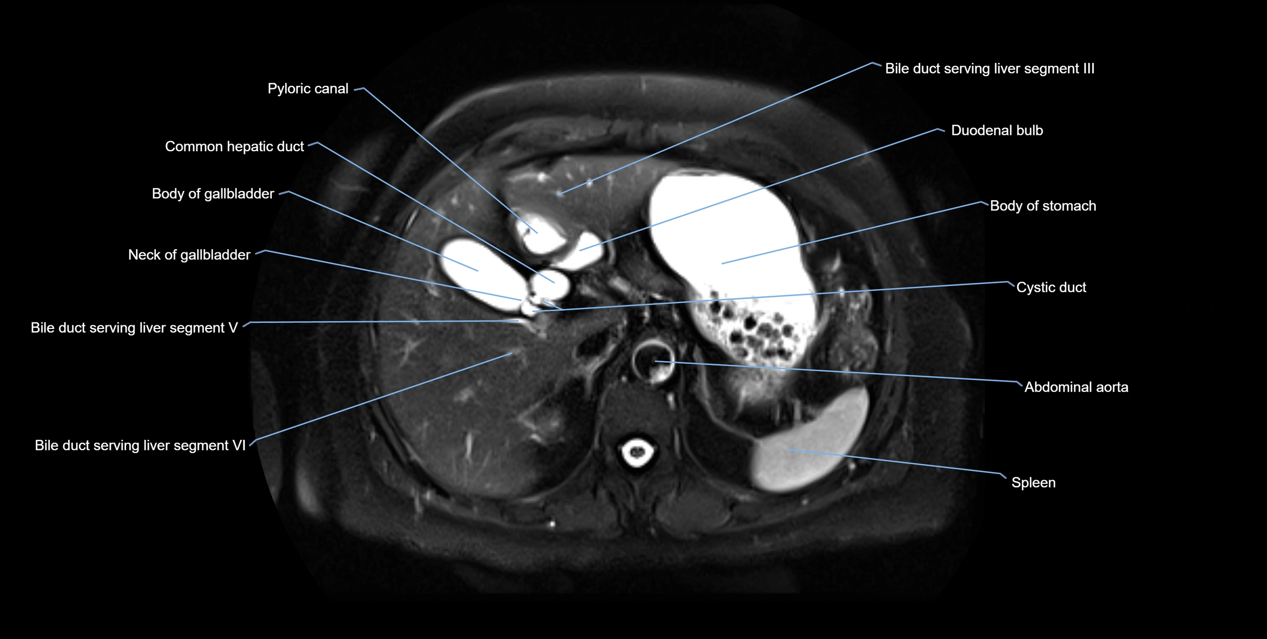 MRI MRCP axial cross sectional anatomy 3T radiology  image-img-10001-00017.webp